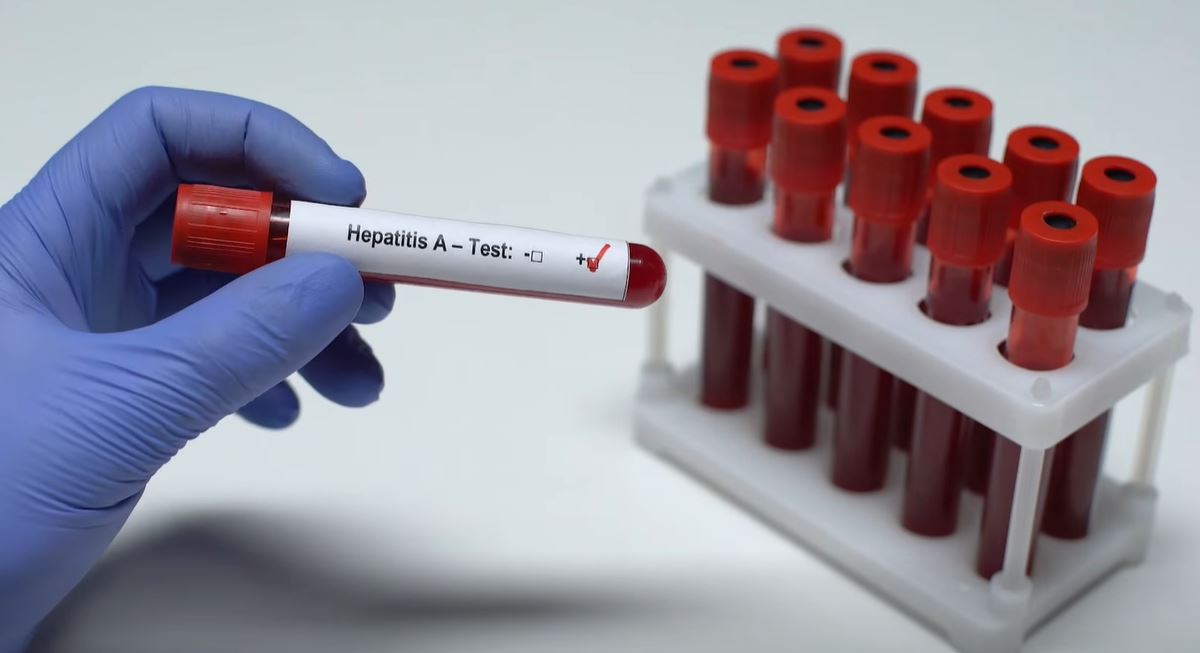 Për herë të parë  Shqipëria miraton Planin Kombëtar për Eliminimin e Hepatiteve Virale