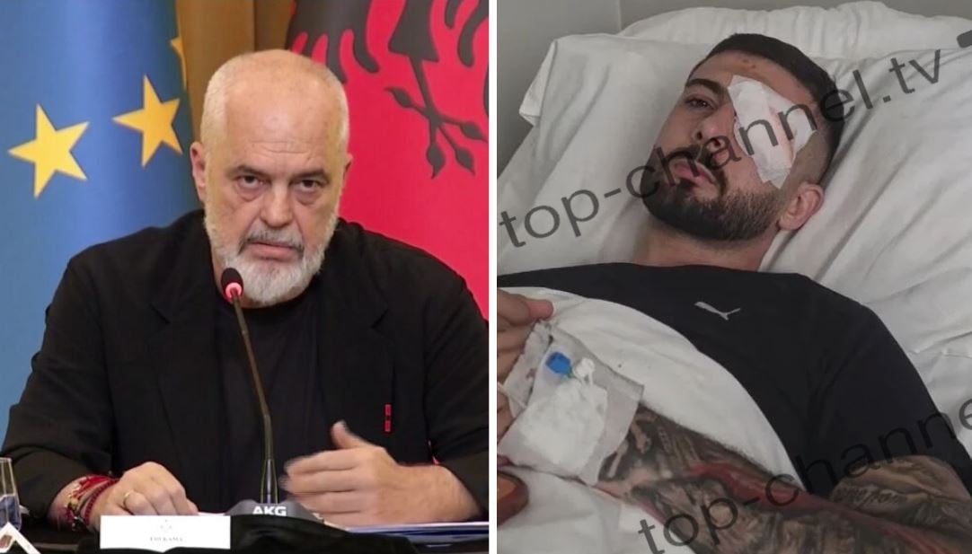Rama reagon për plagosjen e 28-vjeçarit në sy: Pasojë e dhunës, u kujdesa personalisht të shkojë në spitalin më të mirë në Itali